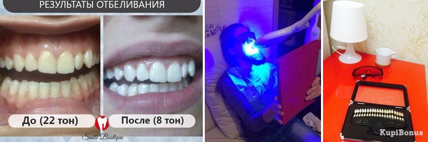 Лазерное отбеливание зубов Томск Ватутина Лечение зубов под наркозом Томск Алеутский 1-й